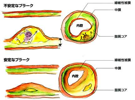 頸動脈エコーは、動脈壁の隆起（プラーク）も観察できます。