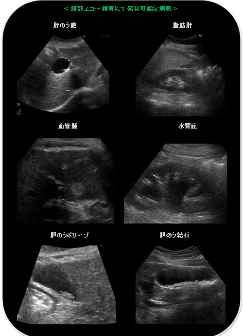 腹部エコー検査にて発見可能な病気